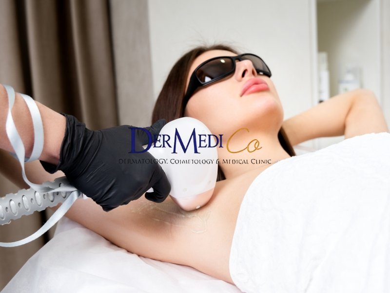 Laser Hair Removal