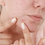 Acne Treatment Delhi