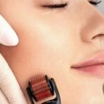 Dermaroller Treatment in Delhi