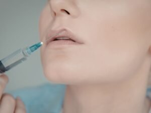 lip fillers in defence colony delhi for natural looking lips and lip enhancement