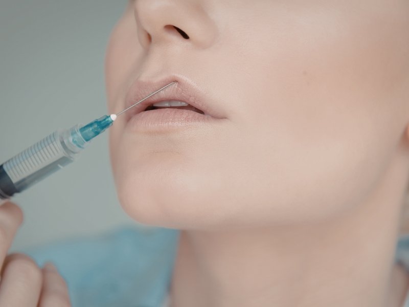 Lip Fillers in Defence Colony