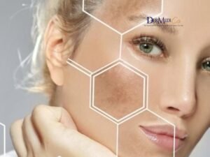 pigmentation treatment in defence colony delhi for dark spots and melasma